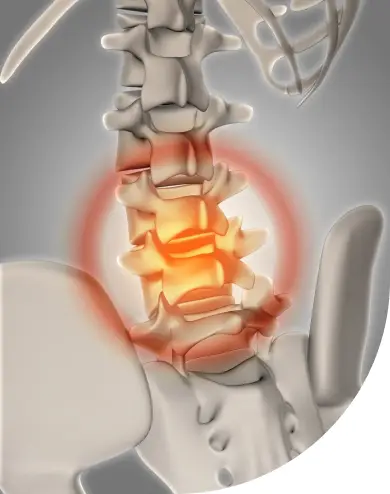 Lumbar Fusion