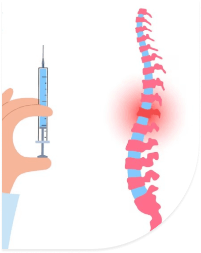 caudal-epidural-injection