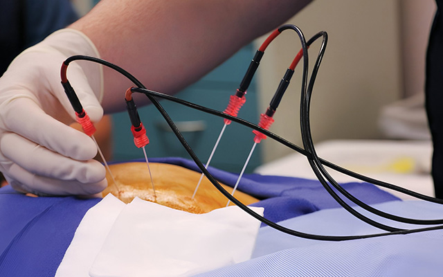 Close-up of a medical professional inserting fine needles connected to electrodes into a patient’s skin during a therapeutic pain-management procedure.