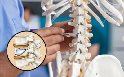 Osteoporotic Spine Fractures: When Is Kyphoplasty the Right Choice?